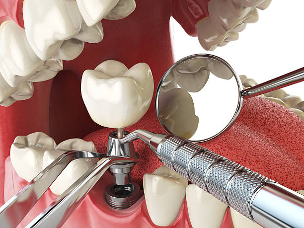 Best Emergency Root Canal Treatment in Wilkesboro, NC